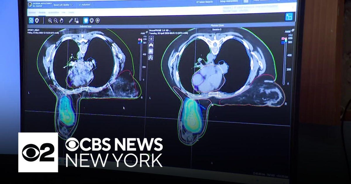New weapon against breast cancer uses AI to make radiation more precise ...