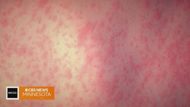 1 measles patient can infect 14 others, even hours after they&rsquo;ve left the room