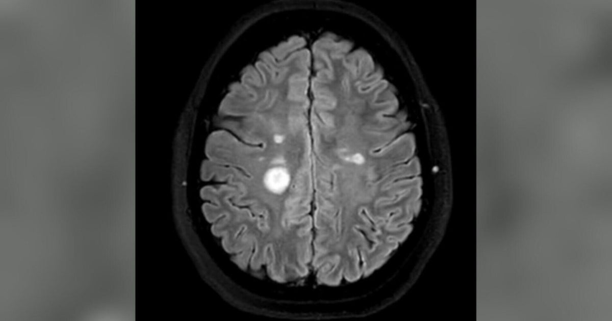 MS misdiagnoses raise concerns, Colorado doctors warn of unnecessary treatment risks