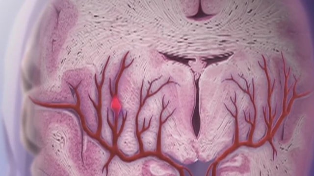 Knowing the signs of a stroke can save lives